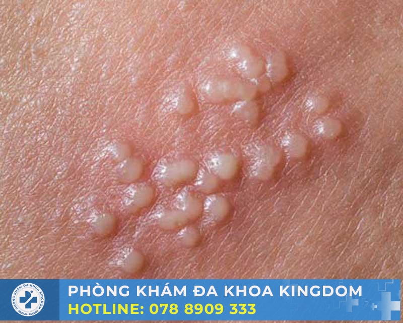 NGUYÊN NHÂN GÂY NỔI MỤN TRẮNG Ở BAO QUY ĐẦU 