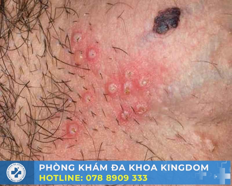 Điều trị bao quy đầu bị đỏ chi phí tối ưu, nhanh khỏi