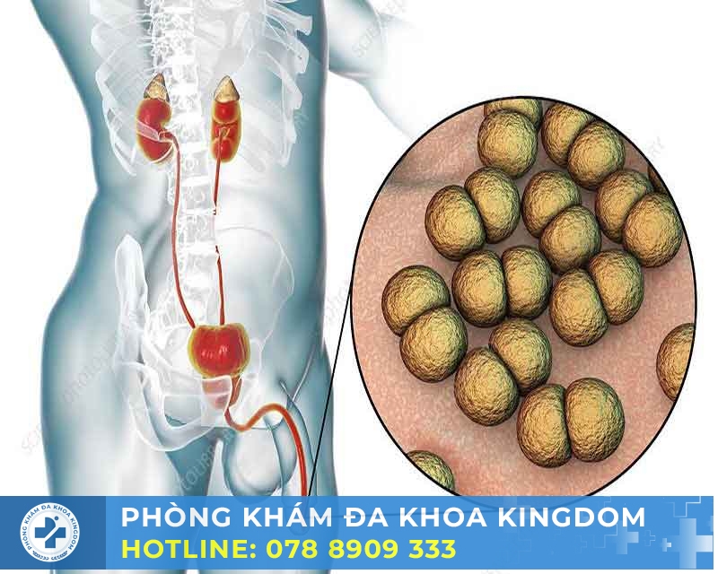 Bệnh lậu có chữa được không? Chi phí điều trị tối ưu