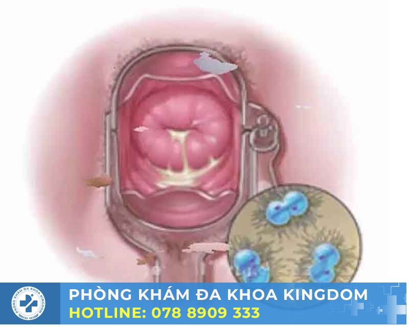 Điều trị bệnh lậu và giang mai với chi phí hợp lý, an toàn