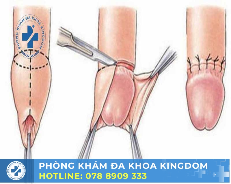 Một số lý do và mục đích cắt bao quy đầu   
