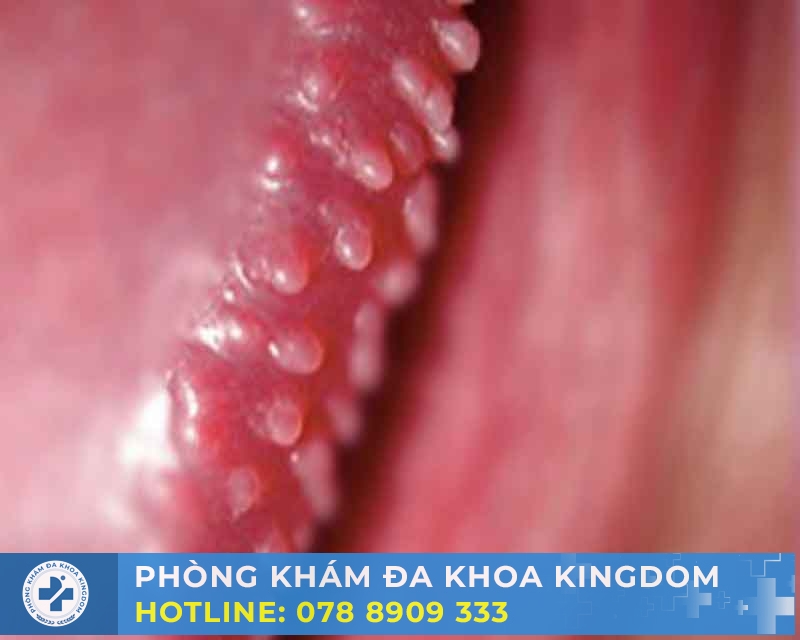  Chuỗi hạt ngọc bao quy đầu là gì?  