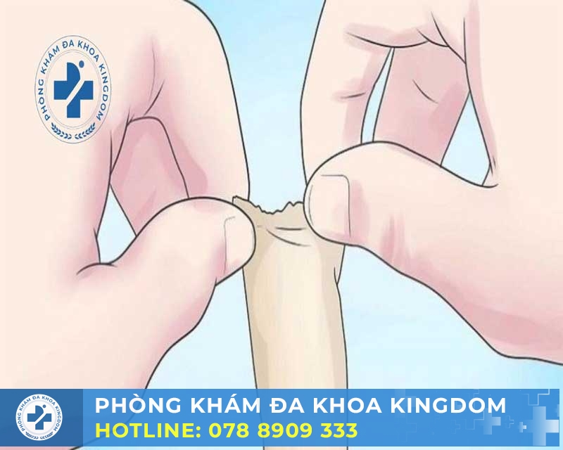 Bao quy đầu dài: Điều trị an toàn với chi phí tốt cho nam giới