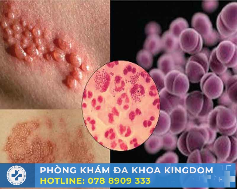 Nhận biết dấu hiệu bệnh lậu và chi phí khám tối ưu