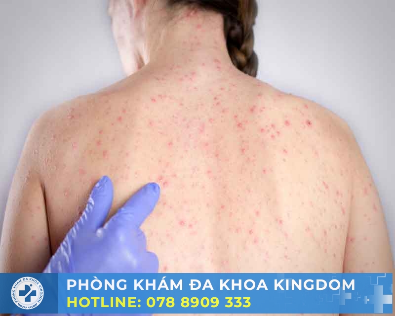 Nhận biết dấu hiệu bệnh giang mai với chi phí khám tối ưu