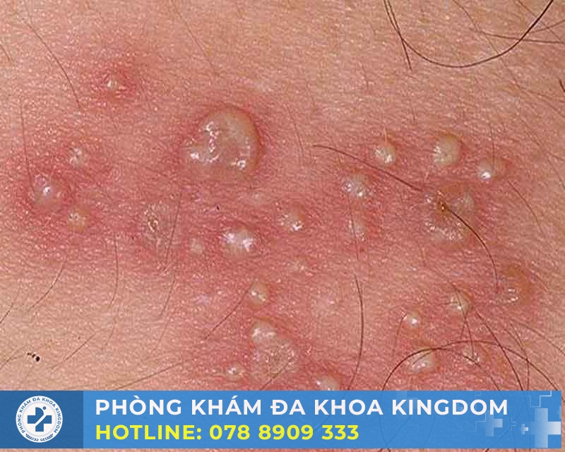 Nhận biết dấu hiệu sùi mào gà để điều trị hiệu quả, chi phí tốt
