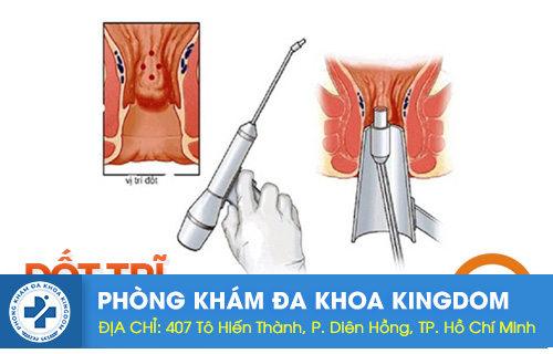 Đốt trĩ có hiệu quả không? Phương pháp chữa trĩ hiệu quả nhất
