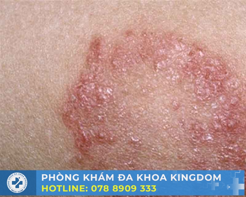 Điều trị giang mai giai đoạn 1 chi phí hấp dẫn, hiệu quả cao