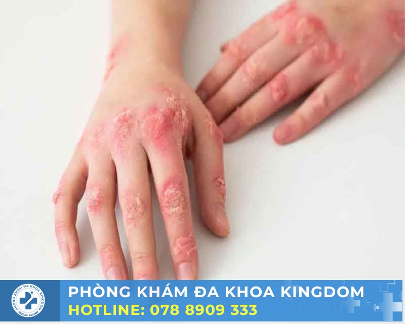 Điều trị giang mai giai đoạn 3 chi phí tốt, an toàn, hiệu quả