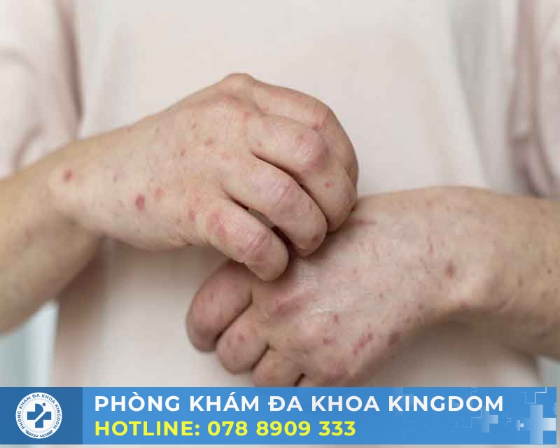 Điều trị bệnh giang mai ở nam chi phí tối ưu, hiệu quả cao