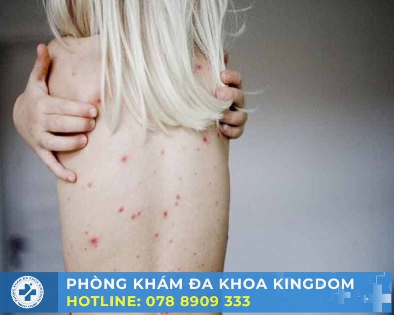 Điều trị bệnh giang mai ở nữ chi phí hợp lý, an toàn