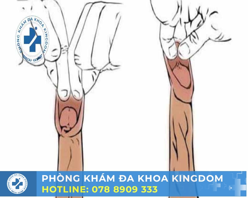 LỜI KHUYÊN CHĂM SÓC CHO NHỮNG NGƯỜI CÓ BAO QUY ĐẦU DÀI