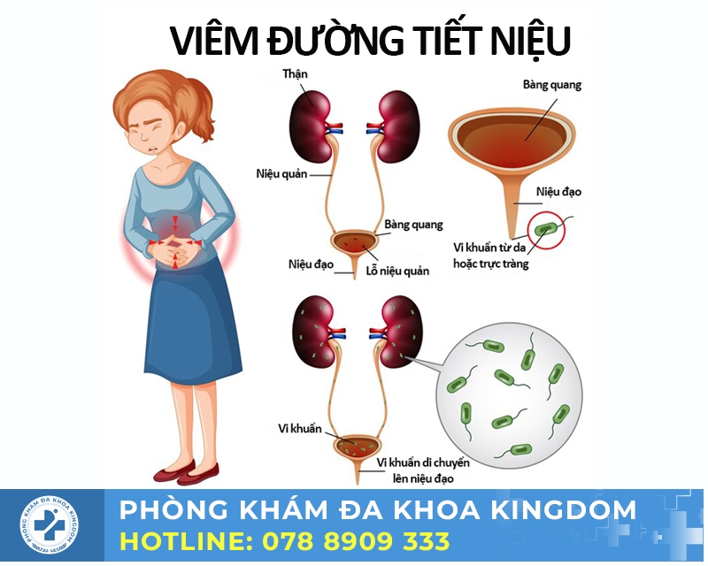 Viêm đường tiết niệu cần được điều trị sớm để mang lại hiệu quả