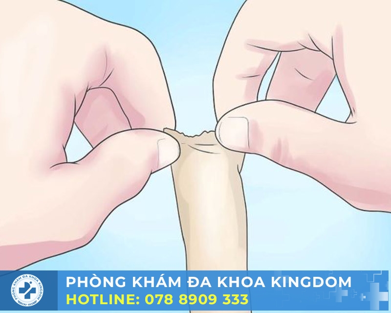 Lột bao quy đầu tại nhà, những điều nên chú ý