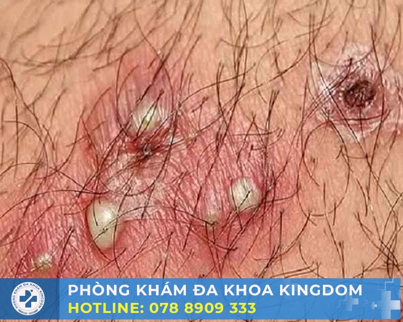 Nổi mụn nhỏ ở rãnh bao quy đầu, điều trị hiệu quả, chi phí tốt