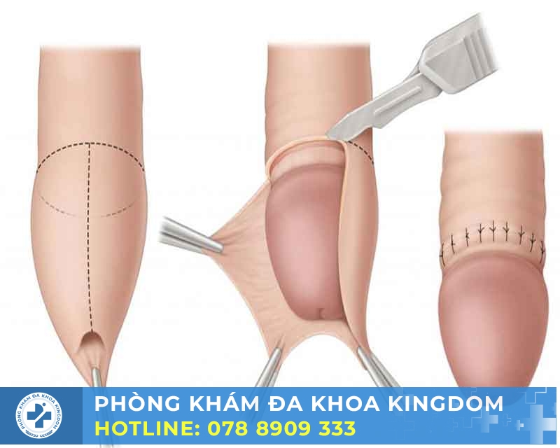 Tại sao lại cần cắt bao quy đầu?