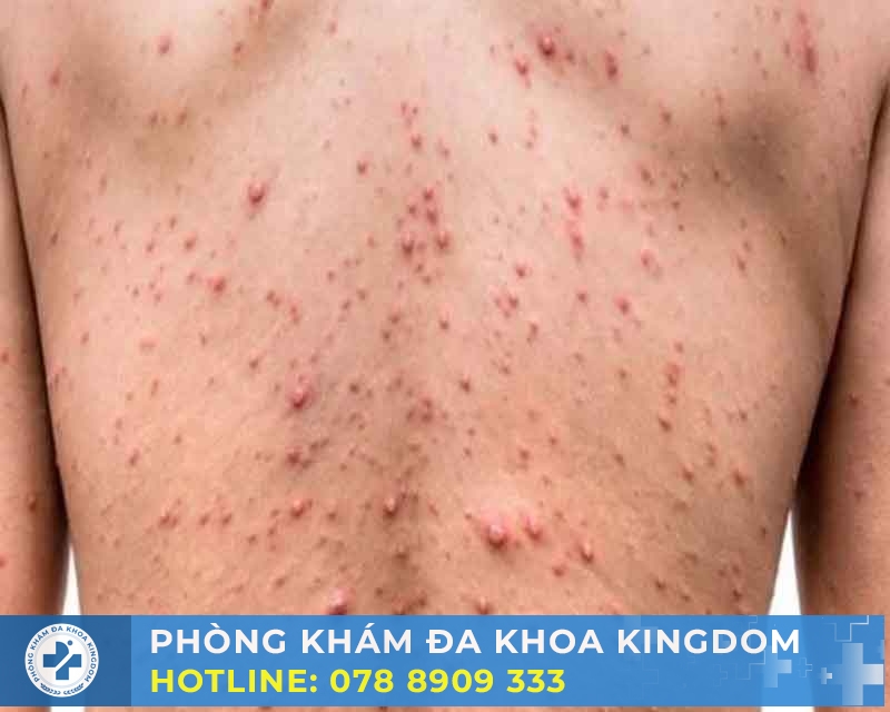Hiểu rõ về săng giang mai và những hệ lụy của nó  
