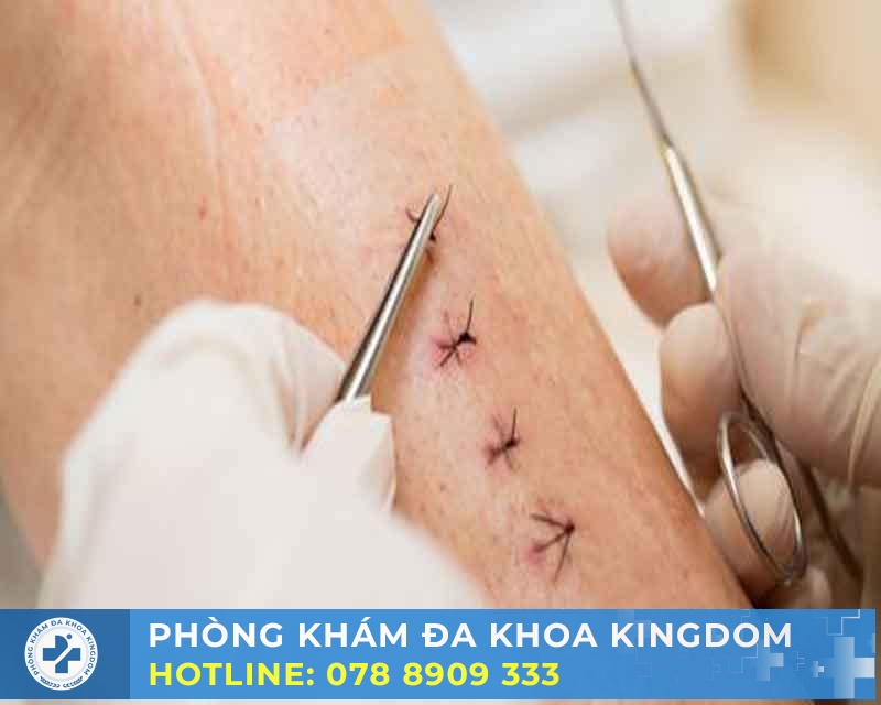 Phòng ngừa sẹo, chìa khóa của quá trình hồi phục 