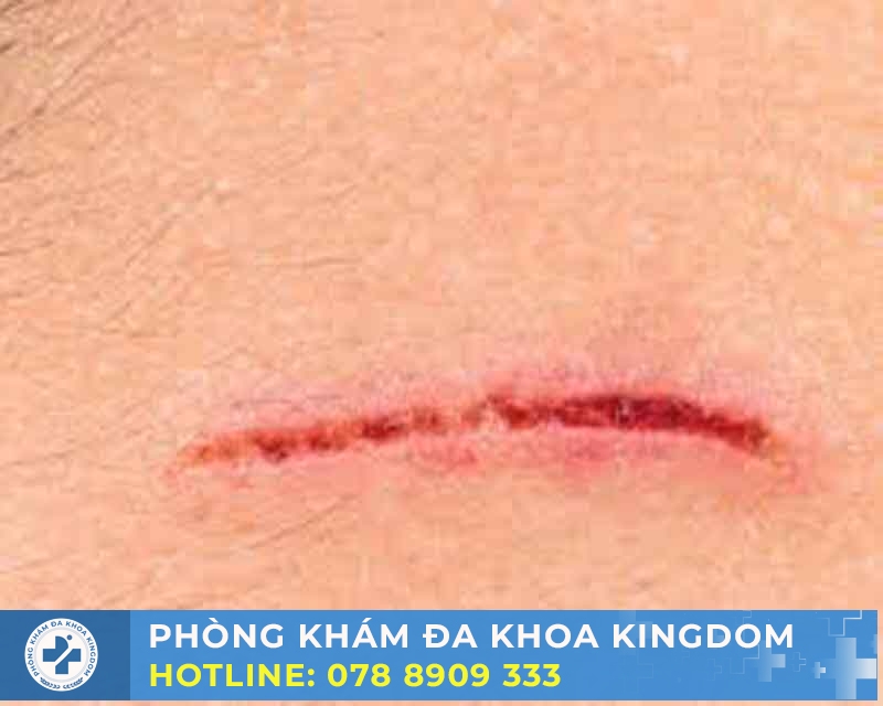 Nguyên nhân gây ra sẹo sau khi cắt bao quy đầu