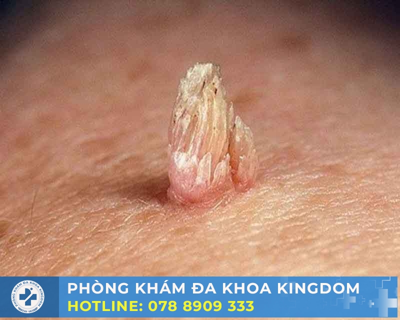 Điều trị sùi mào gà chi phí tốt, an toàn, hiệu quả nhanh
