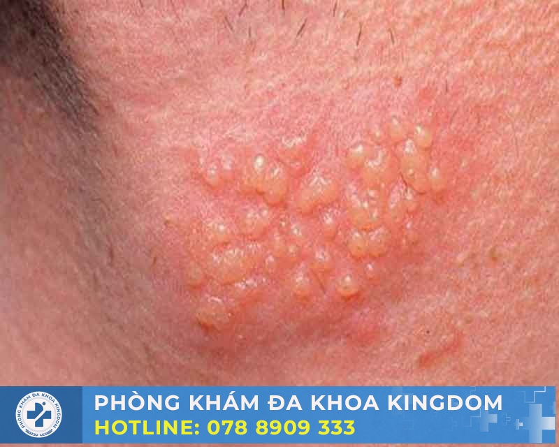 Điều trị sùi mào gà giai đoạn đầu chi phí tốt, hiệu quả cao