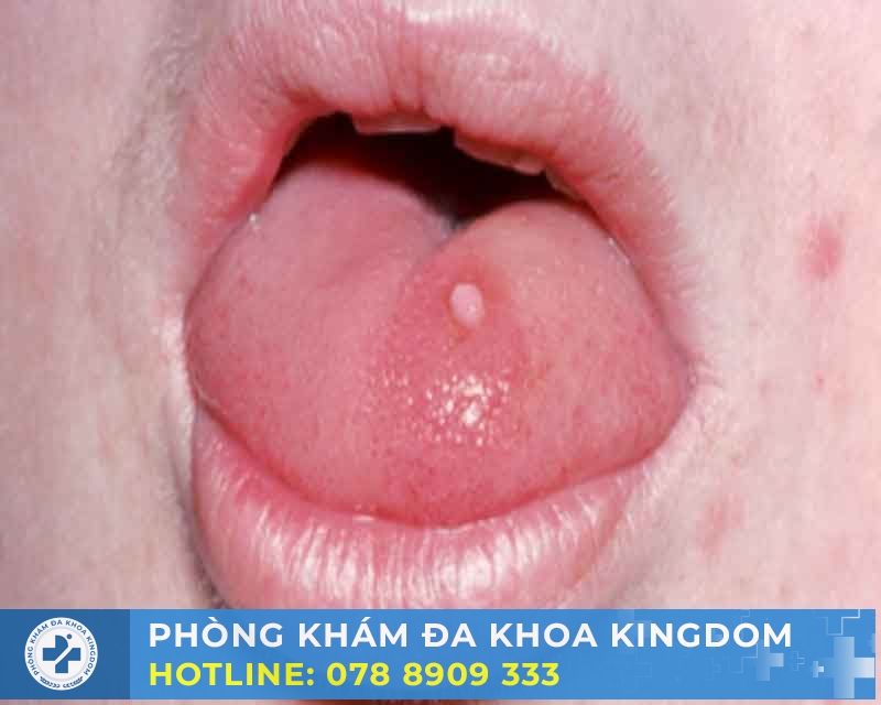 Điều trị sùi mào gà ở lưỡi chi phí tối ưu, nhanh khỏi