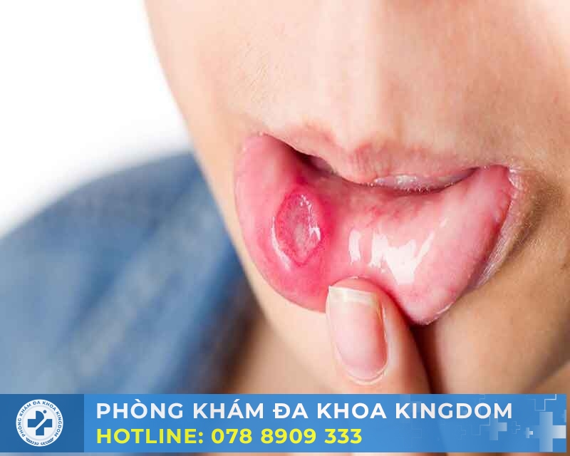 Nguyên nhân gây sùi mào gà ở miệng và các yếu tố rủi ro