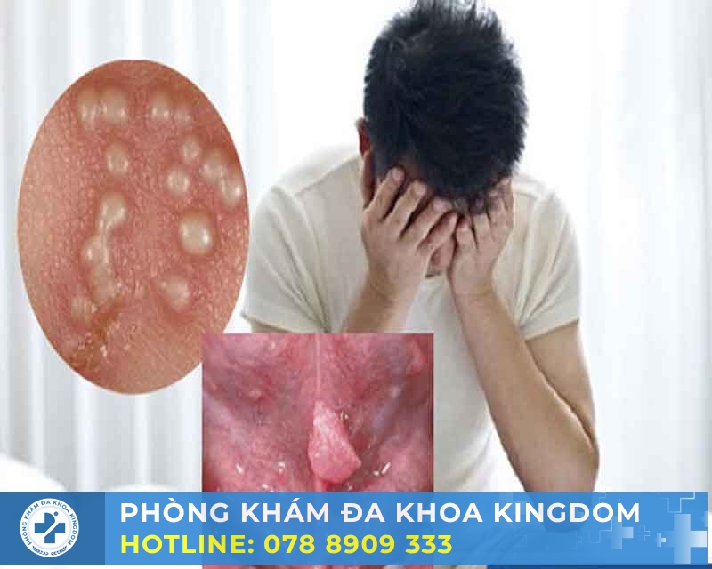 Điều trị sùi mào gà ở nam chi phí hấp dẫn, hiệu quả nhanh