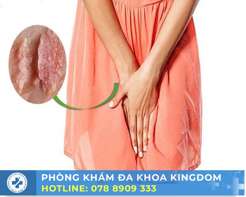 Điều trị sùi mào gà ở nữ chi phí tối ưu, hiệu quả cao