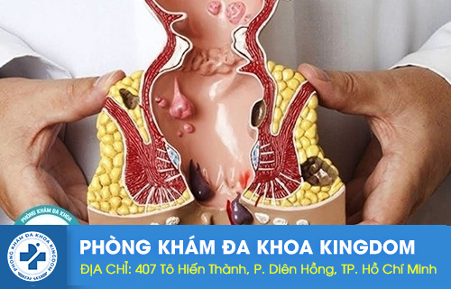 Giai đoạn đầu của bệnh trĩ ngoại biểu hiện ra sao? Cách chữa hiệu quả?