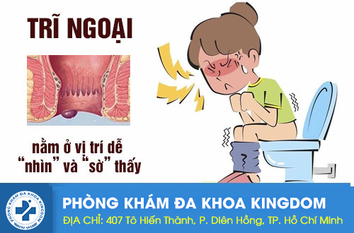Các biểu hiện, triệu chứng của bệnh trĩ ngoại