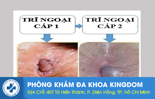 Trĩ ngoại độ 1, độ 2