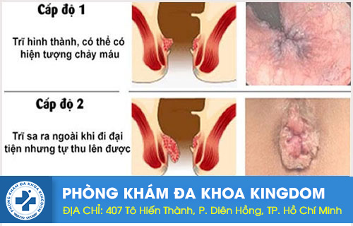 trĩ nội độ 1, độ 2