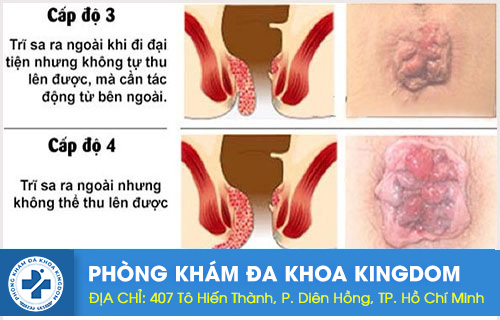 trĩ nội độ 3, độ 4