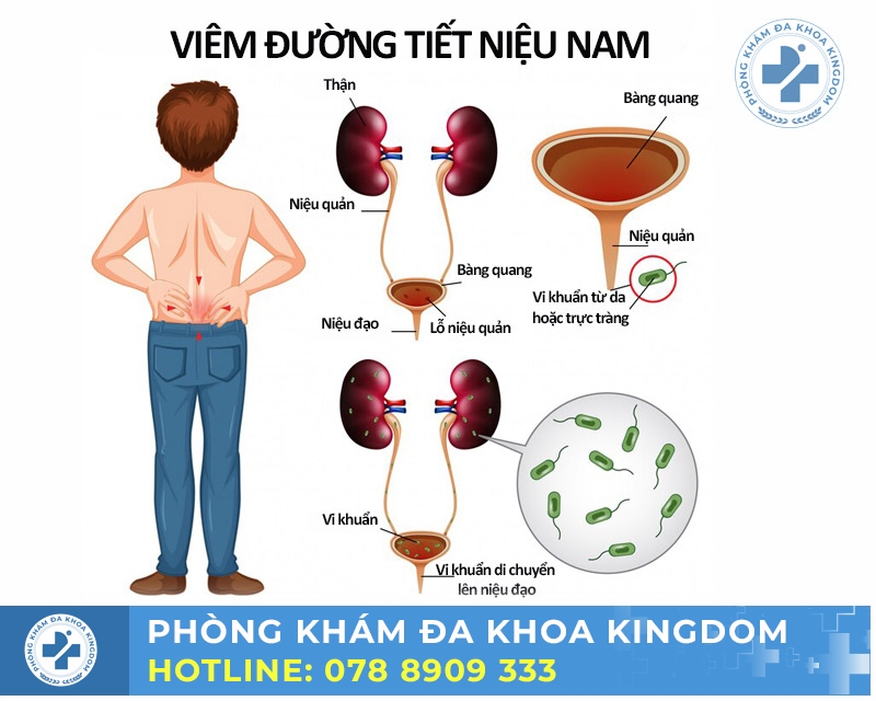 Viêm đường tiết niệu nam nếu phát hiện sớm điều trị sẽ mang lại hiệu quả