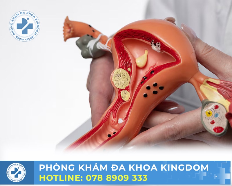 Điều trị viêm đường tiết niệu nữ chi phí tối ưu, hiệu quả cao