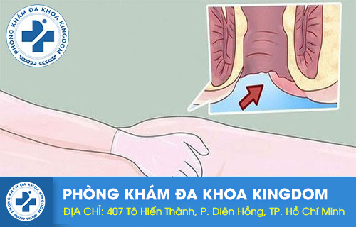 Đau thốn hậu môn là dấu hiệu của bệnh gì?